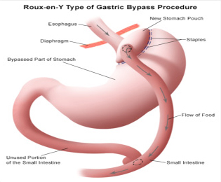 Roux en Y Gastric